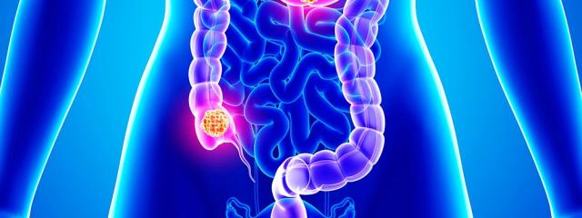 Καρκίνος του Παχέος Εντέρου και του Ορθού