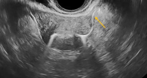 Υπερηχογραφική Σαλπιγγογραφία (HYFOSY): Η Πρωτοποριακή Μέθοδος για τον Ακριβή Έλεγχο Διαβατότητας Σαλπίγγων