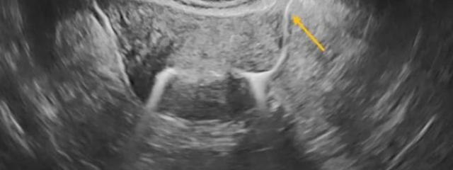 Υπερηχογραφική Σαλπιγγογραφία (HYFOSY): Η Πρωτοποριακή Μέθοδος για τον Ακριβή Έλεγχο Διαβατότητας Σαλπίγγων