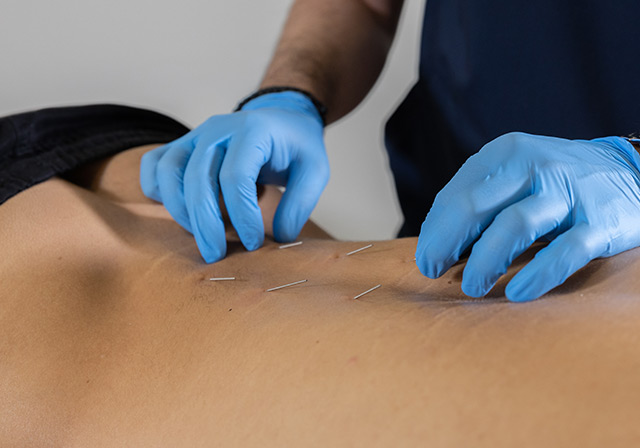 Βελονισμός <br> (Dry Needling) 