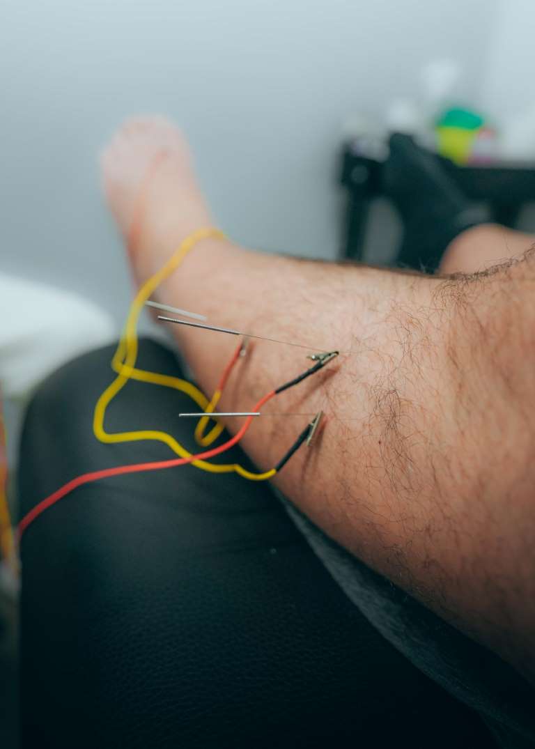 Βελονισμός & Ηλεκτροβελονισμός 