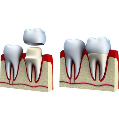 ΠΡΟΣΘΕΤΙΚΗ ΑΠΟΚΑΤΑΣΤΑΣΗ 